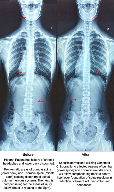 Spinal Misalignments Of Lumbar And Thoracic Spine Causing Compensatory