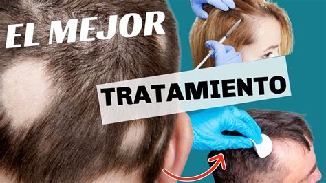 Alopecia Areata Tratamiento En Hombres Y Mujeres YouTube