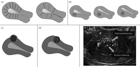 Terms Definitions And Measurements To Describe Sonographic Features Of