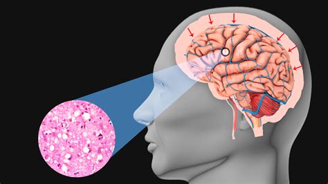 Conoce La Patolog A Que Puede Tapar El Diagn Stico De Demencia