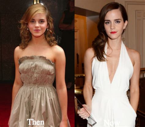 Emma Watson Boob Job And Other Plastic Surgery Before And After