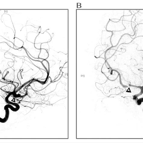 Anterior Communicating Artery Aneurysm Arrowhead Before A And After Download Scientific