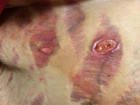 Ulceration Of Corticosteroid Induced Striae Photograph Of Ulcerations