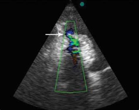 Modified Two Dimensional Echocardiogram With Color Flow Doppler In The