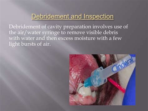 Principles Of Cavity Preparation Ppt