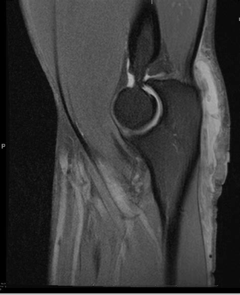 Subdeltoid Bursitis Mri