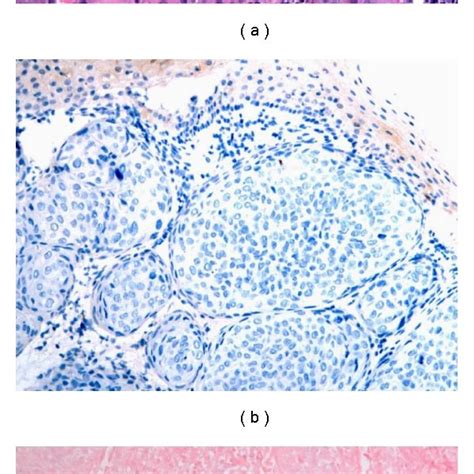 Moderately Differentiated Squamous Cell Carcinoma Hematoxylin And Download Scientific Diagram