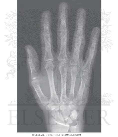 Right Hand X Ray Normal