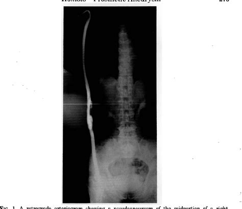 Figure 1 From Prosthetic Aneurysm In An Axillofemoral Dacron Bypass Graft Semantic Scholar