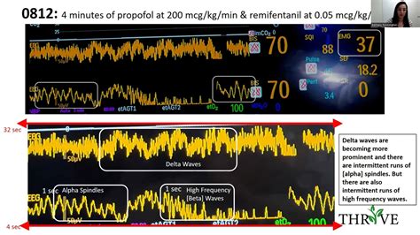 Using Eeg Wave Forms Pharmacokinetic Modeling During Induction