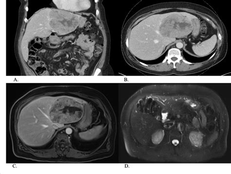 Figure From The Surgical Management Of Metastatic Pancreatic Acinar