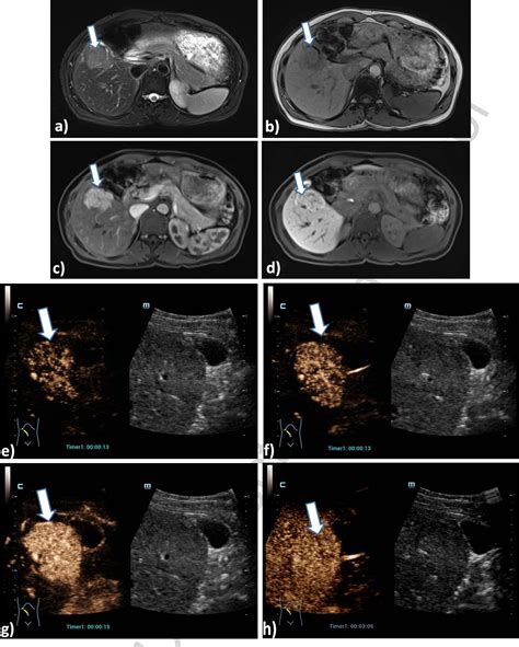 Figure 6 From Modified Contrast Enhanced Ultrasonography With The New