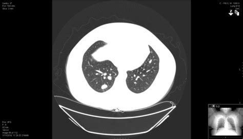 -Chest CT scan demonstrating multiple noncalcified lung nodules with... | Download Scientific ...