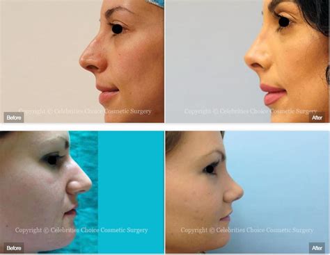 Nasal Tip And Upper Lip Lift Options Best Plastic Surgeon Orlando