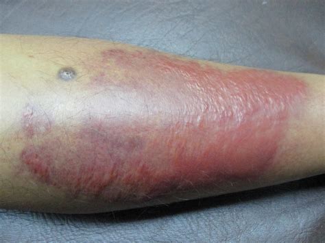European Hornet Sting Treatment: Cellulitis Causes And Treatment