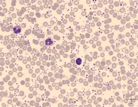 Exame De Plaquetas Para Que Serve - Contagem De Plaquetas Humanas O Sangue é Essencial Para A Vida, Mas
