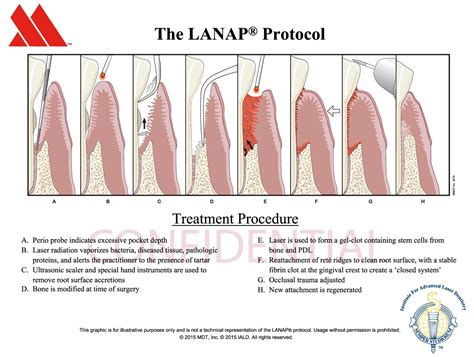 How Does Lanap Work Sydney Laser Gum Centre