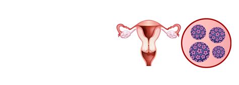 Genital Wart Treatment In Kolkata Cmri Hospital