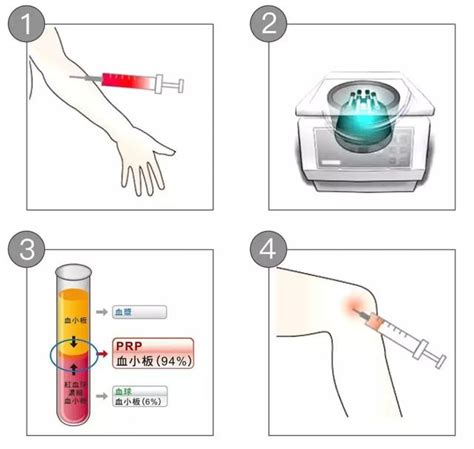什么是prp治疗？ 好大夫在线