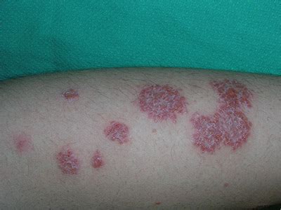 Eczema Circular Rash