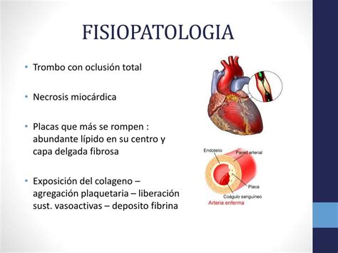 Ppt Infarto Del Miocardio Con Elevaci N Del Segmento St Powerpoint