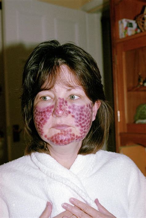 Rosacea Treatment Photograph By Alex Bartel Science Photo Library