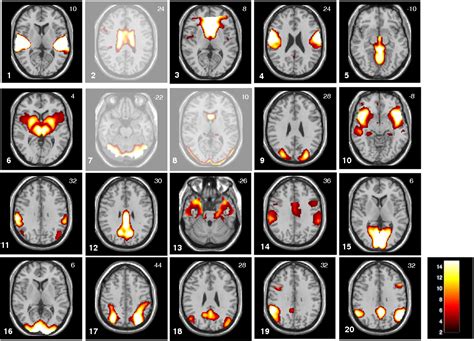 Table 1 From Dynamic Reconfiguration Of Human Brain Functional Networks