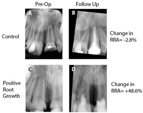 Figure 2 From A Standardized Novel Method To Measure Radiographic Root