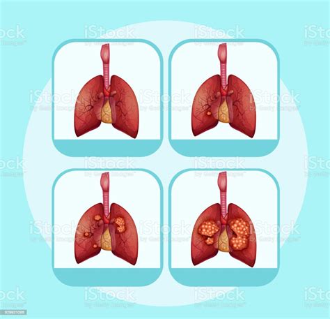 Diagram Showing Different Stages Of Lung Cancer Stock Illustration - Download Image Now ...