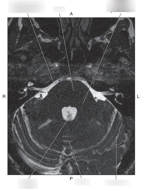 Diagram Of 378 Axial T2 Weighted Mri Of Middle Cerebellar Peduncles Quizlet