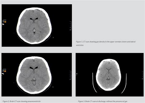 Figure 1 From Symptomatic Pneumocephalus As A Complication Of Lumbar