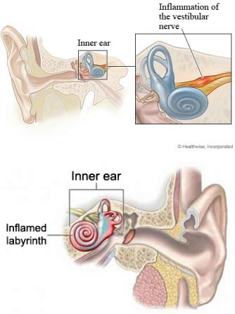 Vestibular Neuritis Labyrinthitis Differential Diagnosis For Vertigo