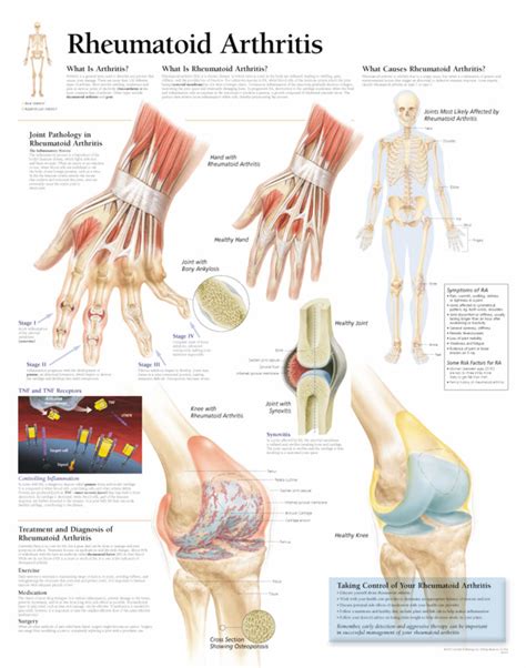 Rheumatoid Arthritis | Scientific Publishing