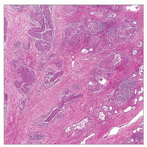 Urothelial Carcinoma Of Prostate Basicmedical Key