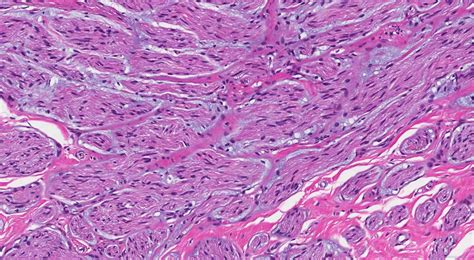 Traumatic Neuroma Atlas Of Pathology