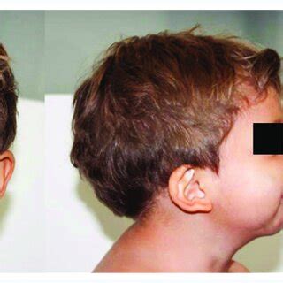 A: frontal and lateral phenotypic features of Robinow syndrome ...