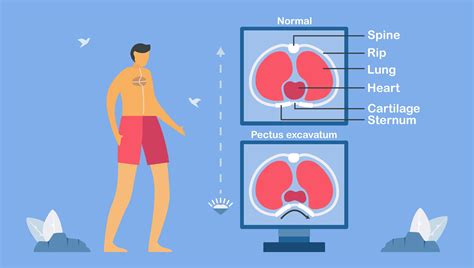 Pectus excavatum is a structural deformity 1228885 Vector Art at Vecteezy