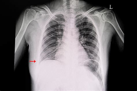 A Chest Xray Film Showing Peptic Ulcer Perforation Stock Photo