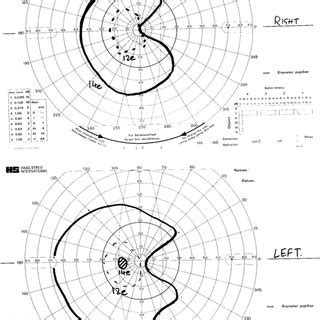 Right A And Left B Fundus Photographs Showing Atrophy Of The