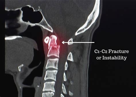 atlantoaxial instability   neck fracture specialist clear lake
