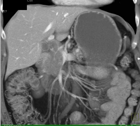 Pancreatic Cancer Encases The Pv Smv And Also Invades The Duodenum