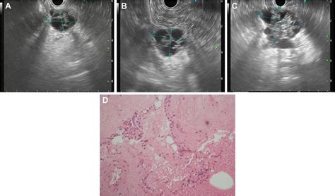 Natural Evolution Of Pancreatic Serous Cystadenoma On Endoscopic