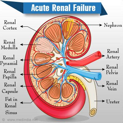 Acute Renal (Kidney) Failure- Causes, Symptoms, Diagnosis, Treatment ...