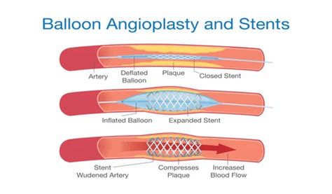 cardiovascular stent coronary stent  laboratory  rs