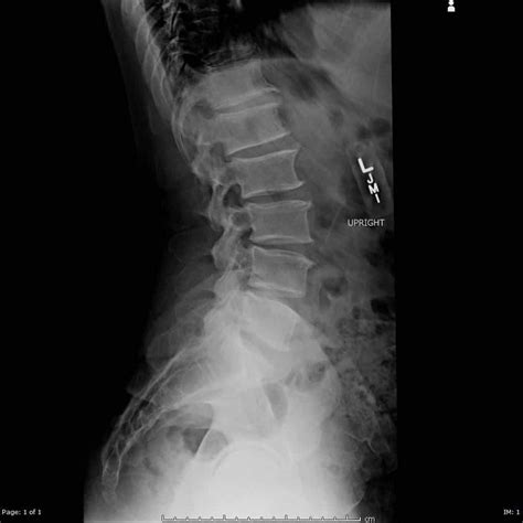 X-Ray Spine - Oregon Advanced Imaging