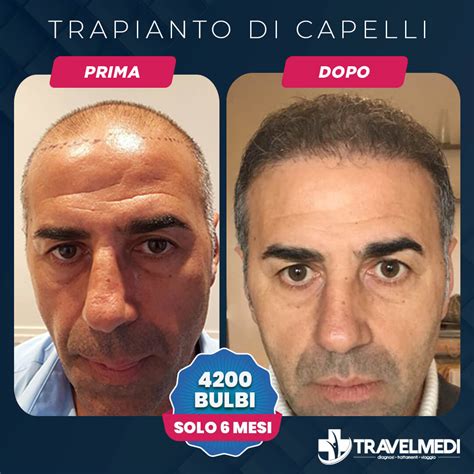 Trapianto Di Capelli Dhi Prezzi Prima E Dopo