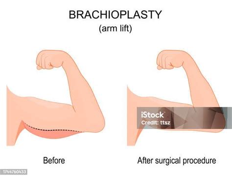 Brachioplasty Before And After Surgical Procedure Stock Illustration - Download Image Now - iStock