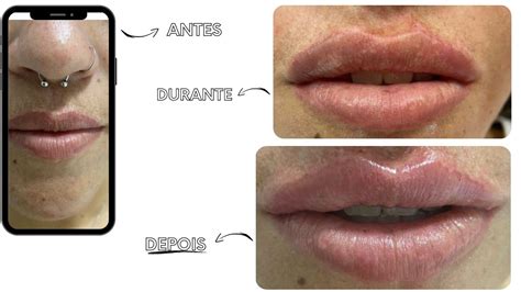 Quanto Tempo Dura O Preenchimento Labial Descubra