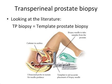 Whats Involved In A Prostate Biopsy