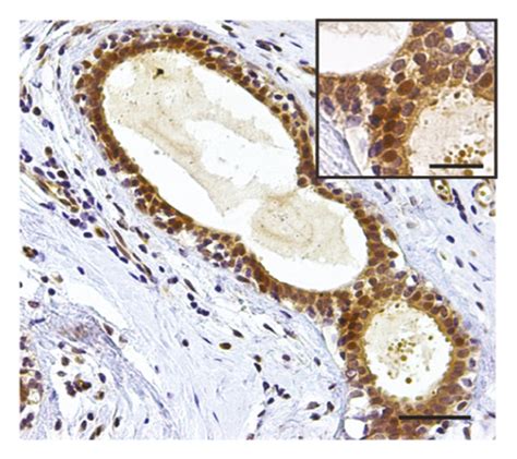 Normal And Abnormal Level Of Kaiso Expression Download Scientific